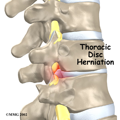The Effects Of Physiotherapy On A Herniated Disc