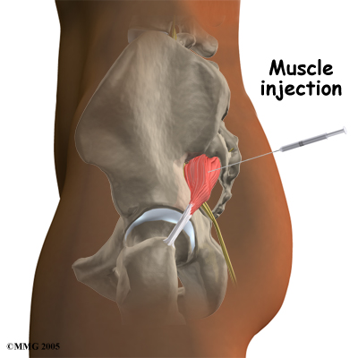 Finding Comfort: How to Sit with Piriformis Syndrome and Relieve Pain -  Kinetic Labs