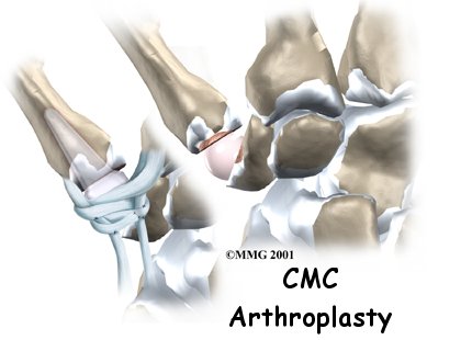 Artificial Joint Replacement of the Thumb - My Health Team's Guide