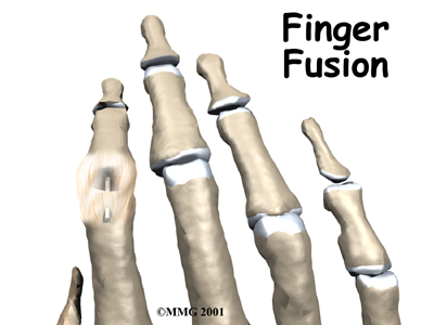 Finger Fusion Surgery - My Health Team's Guide