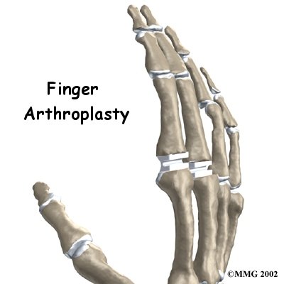 Artificial Joint Replacement of the Finger - My Health Team's Guide