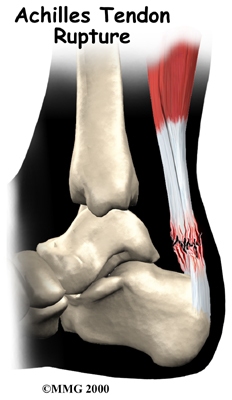 Achilles Tendonitis Redcliffe