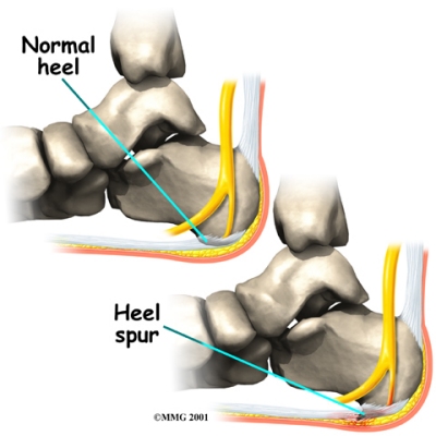 Heel Spur Syndrome | Foot & Ankle Doctors, Inc.