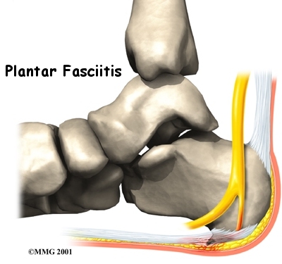 Plantar Fasciitis Treatment Exercises - Physiotherapist Brisbane City,  Physio Therapy