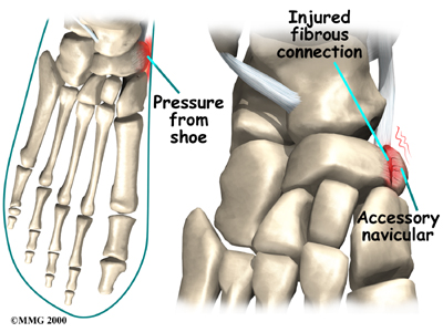 Physiotherapy in Redcliffe for Accessory Navicular Problems