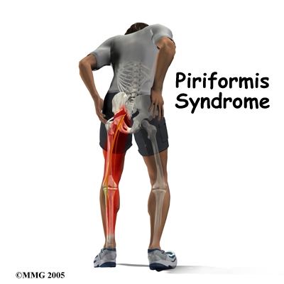 Finding Comfort: How to Sit with Piriformis Syndrome and Relieve Pain -  Kinetic Labs